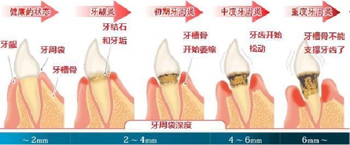 间充质干细胞-治疗牙龈萎缩