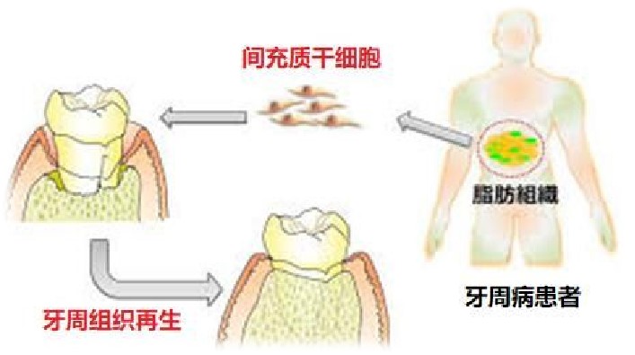 间充质干细胞-治疗牙龈萎缩