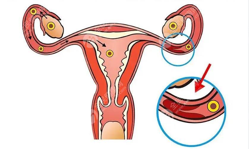 输卵管切除术后会不会宫外孕？