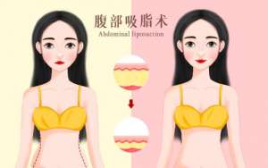 杭州市腰腹吸脂哪几家医院好