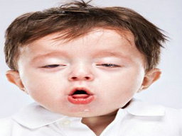 小儿肺热咳嗽的症状有哪些