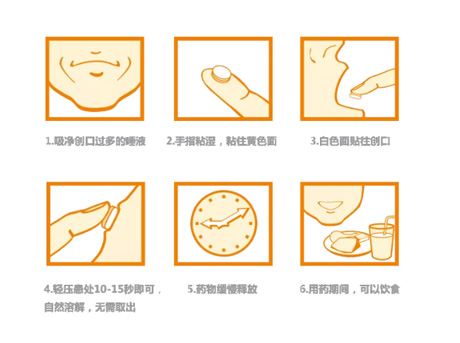 意可贴可治疗口腔溃疡吗？对症治疗，效果惊人！