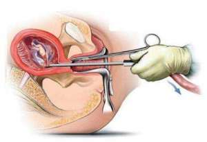 人流后恢复要多久才能痊愈？