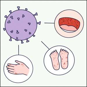 小儿肠道病毒与手足口病的关系，原来是这么回事