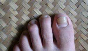 灰指甲初期图片啥样儿？早诊断早治疗