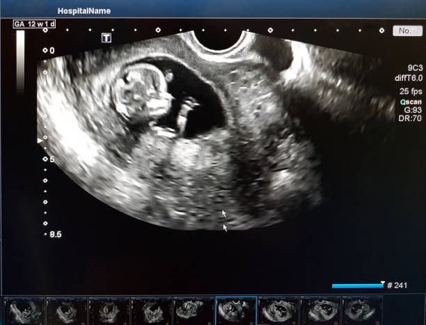 子宫息肉做第三代试管婴儿流程是什么样的？