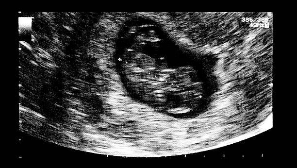 子宫畸形做试管婴儿价格是多少？