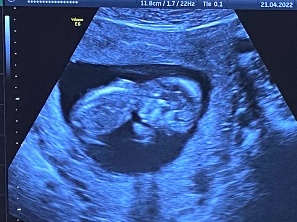 幼稚子宫做试管婴儿多少钱？
