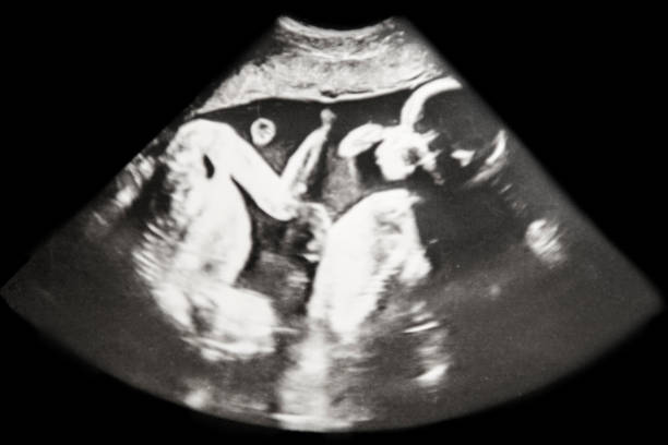 子宫畸形能做试管婴儿吗？