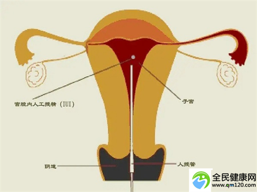 试管婴儿泰国第三代（泰国三代试管去除鱼鳞病）