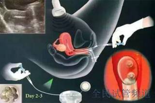 输卵管积水影响大庆三代试管婴儿助孕吗？