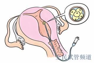 高龄做天水三代试管婴儿助孕要准备什么？