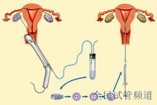 阳江三代试管婴儿助孕胚胎质量不好与什么有关？