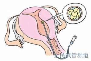 拉拉试管费用揭秘,les生育价格参考