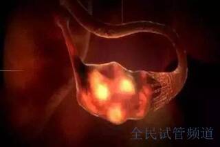 精子太少做不成试管婴儿?