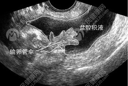 湖南做试管宫腔积液对成功率影响大吗？