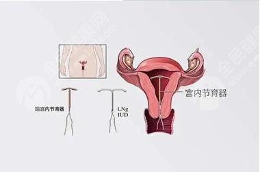 节育环下移了就必须取出来然后接着再带一个吗？