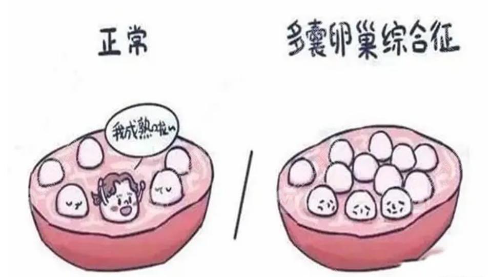 多囊打排卵针可以帮助排卵吗？