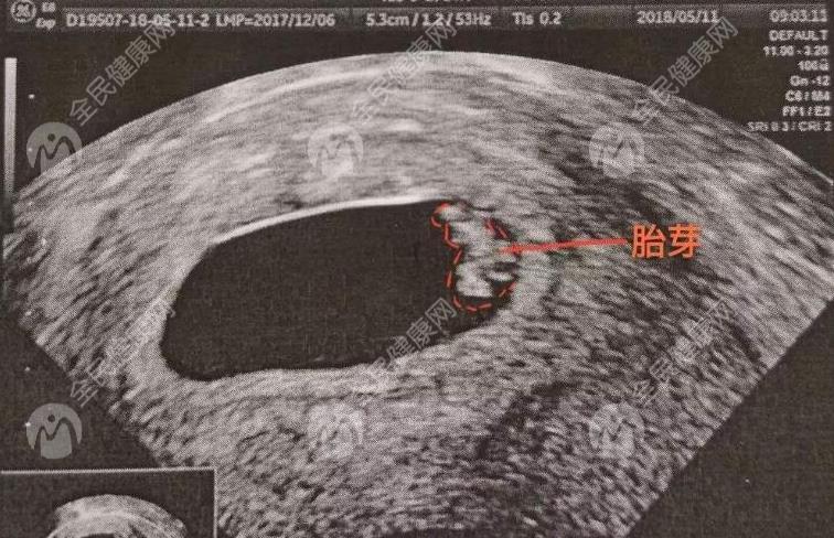 安徽地区有哪些私立的机构可以<em>做</em>试管技术?一代试管婴儿会不会鲜胚移植后出现30%嵌合性胚胎？