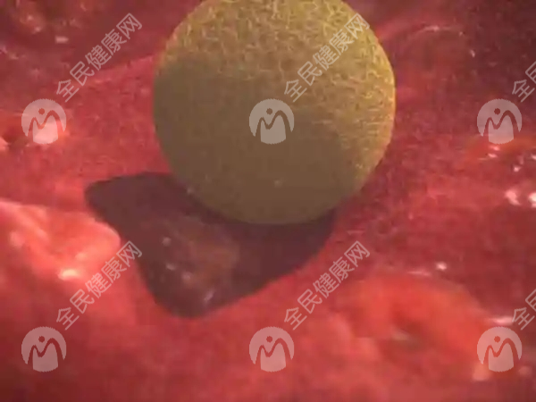 子宫腺肌症可以选择介入治疗吗？