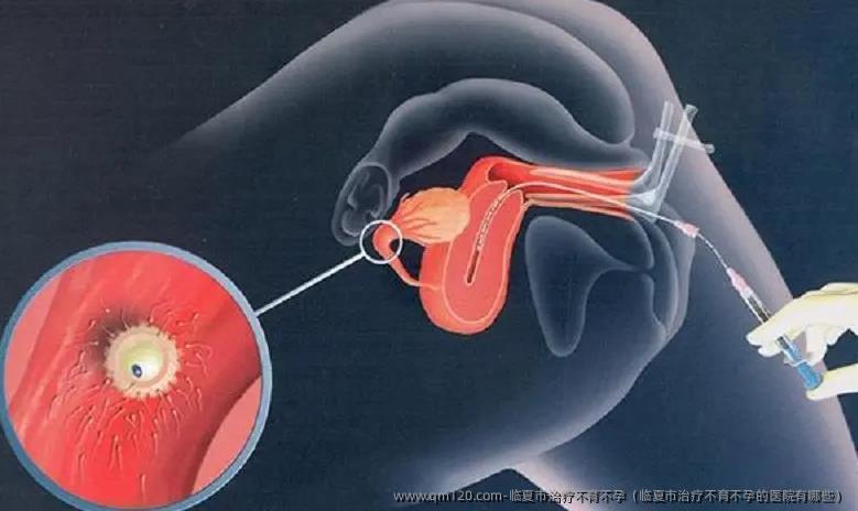 临夏市治疗不育不孕（临夏市治疗不育不孕的医院有哪些）