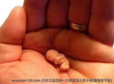 大同三医院做一次试管婴儿多少钱(费用贵不贵)
