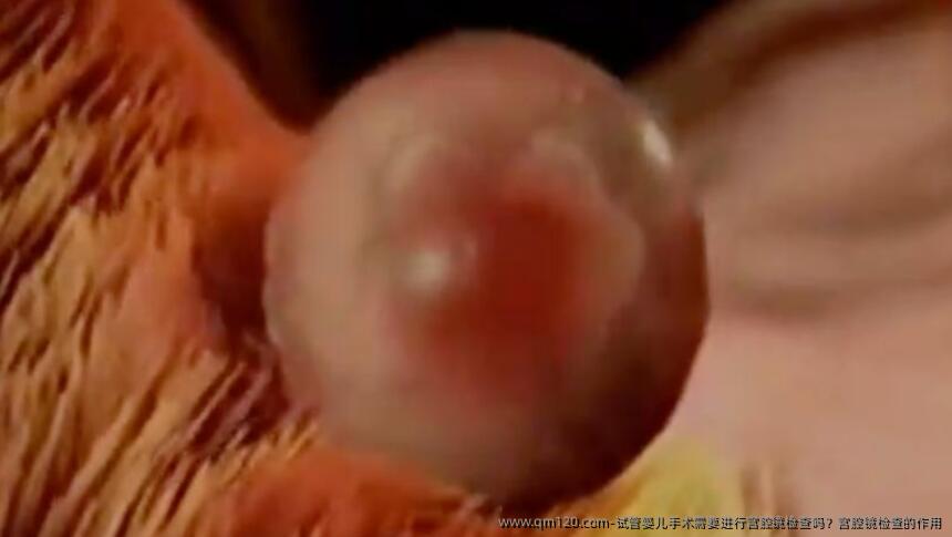 试管婴儿手术需要进行宫腔镜检查吗？宫腔镜检查的作用
