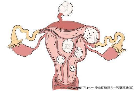 中山试管婴儿一次能成功吗？