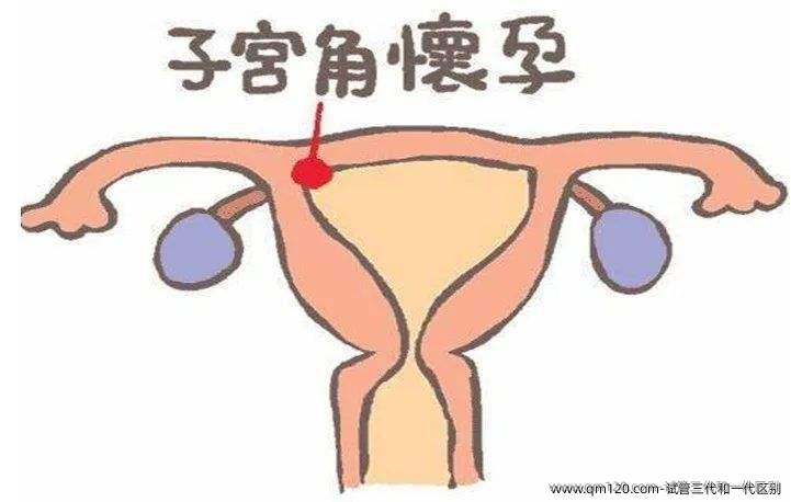 试管三代和一代区别