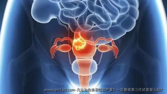 几号染色体易位较严重？一定要做第<a href=