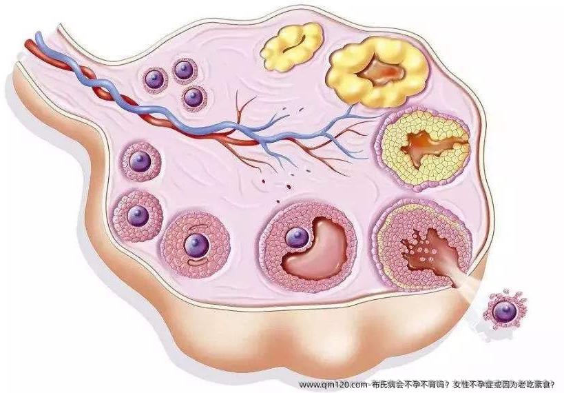 布氏病会不孕不育吗？女性不孕症或因为老吃素食？