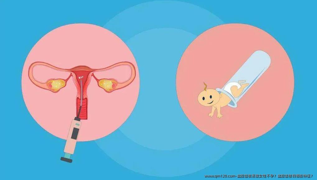 盆腔结核易致女性不孕？盆腔结核有哪些特征？