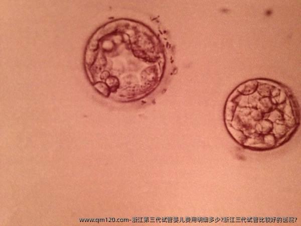 浙江第三代试管婴儿费用明细多少?浙江三代试管比较好的医院?