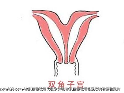腺肌症做试管大概多少钱 腺肌症做试管能成功吗容易着床吗 